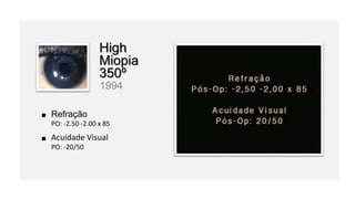 Refração
PO: -2.50 -2.00 x 85
Acuidade Visual
PO: -20/50
High
Miopia
350º
1994
 