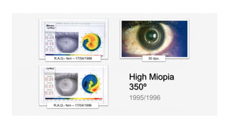High Miopia
350º
1995/1996
R.A.G.- fem – 17/04/1996
R.A.G.- fem – 17/04/1996
30 dpo.
 