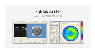 High Miopia 350º
2006 - 11 years follow up
 