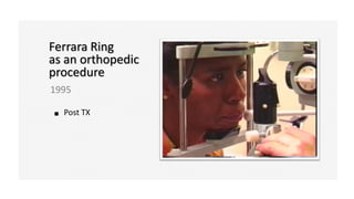Ferrara Ring
as an orthopedic
procedure
1995
Post TX
 