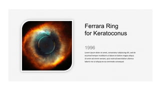 Ferrara Ring
for Keratoconus
1996
Lorem ipsum dolor sit amet, consectetur adipiscing elit, sed do
eiusmod tempor incididunt ut labore et dolore magna aliqua.
Ut enim ad minim veniam, quis nostrud exercitation ullamco
laboris nisi ut aliquip ex ea commodo consequat.
 