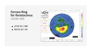Ferrara Ring
for Keratoconus
20/08/1996
UCVA 20 | 400
BSCVA 20 | 40
 