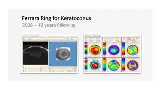 Ferrara Ring for Keratoconus
2008 – 16 years follow up
 