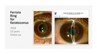 2018
23 years
follow up
Ferrara
Ring
for
Keratoconus
 