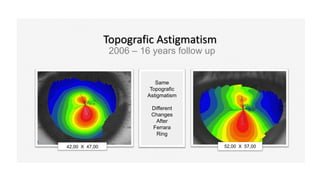 Topografic Astigmatism
2006 – 16 years follow up
42,00 X 47,00 52,00 X 57,00
Same
Topografic
Astigmatism
Different
Changes
After
Ferrara
Ring
 