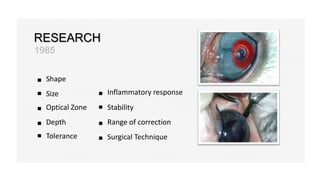 RESEARCH
1985
Shape
Size
Tolerance
Optical Zone
Depth
Inflammatory response
Stability
Range of correction
Surgical Technique
 