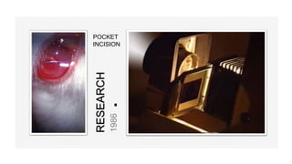 POCKET
INCISION
RESEARCH
1986
 