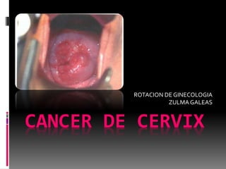 CANCER DE CERVIX
ROTACION DE GINECOLOGIA
ZULMAGALEAS
 