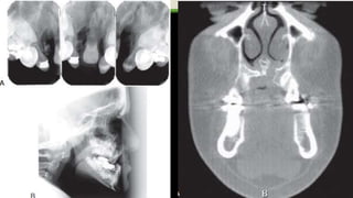 Radiographic Features of Developmental Anomalies in the Face and Jaws ...