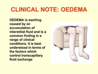 CLINICAL NOTE: OEDEMA OEDEMA is swelling caused by an accumulation of interstitial fluid and is a common finding in a range of clinical conditions. It is best understood in terms of the factors which control transcapillary fluid exchange 