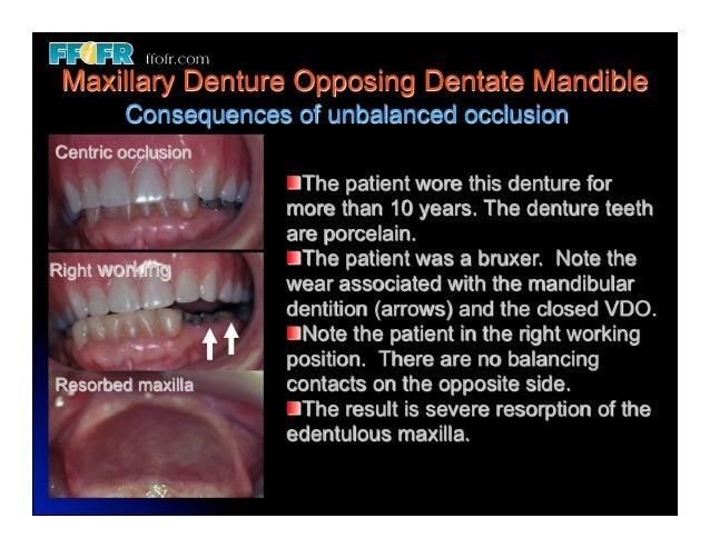 Dentures And Natural Teeth  - A Partial Denture Is Attached To The Teeth Either Side Of The Gap And Replaces One Or A Few Missing Teeth.