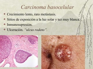 Ulcus Rodems 31. PatologíA De Piel | PPT