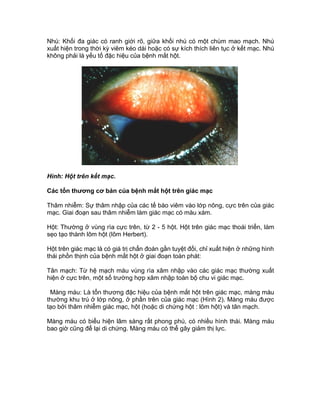 Nhú: Khối đa giác có ranh giới rõ, giữa khối nhú có một chùm mao mạch. Nhú
xuất hiện trong thời kỳ viêm kéo dài hoặc có sự kích thích liên tục ở kết mạc. Nhú
không phải là yếu tố đặc hiệu của bệnh mắt hột.
Hình: Hột trên kết mạc.
Các tổn thương cơ bản của bệnh mắt hột trên giác mạc
Thâm nhiễm: Sự thâm nhập của các tế bào viêm vào lớp nông, cực trên của giác
mạc. Giai đoạn sau thâm nhiễm làm giác mạc có màu xám.
Hột: Thường ở vùng rìa cực trên, từ 2 - 5 hột. Hột trên giác mạc thoái triển, làm
sẹo tạo thành lõm hột (lõm Herbert).
Hột trên giác mạc là có giá trị chẩn đoán gần tuyệt đối, chỉ xuất hiện ở những hình
thái phồn thịnh của bệnh mắt hột ở giai đoạn toàn phát:
Tân mạch: Từ hệ mạch máu vùng rìa xâm nhập vào các giác mạc thường xuất
hiện ở cực trên, một số trường hợp xâm nhập toàn bộ chu vi giác mạc.
Màng máu: Là tổn thương đặc hiệu của bệnh mắt hột trên giác mạc, màng máu
thường khu trú ở lớp nông, ở phần trên của giác mạc (Hình 2). Màng máu được
tạo bởi thâm nhiễm giác mạc, hột (hoặc di chứng hột : lõm hột) và tân mạch.
Màng máu có biểu hiện lâm sàng rất phong phú, có nhiều hình thái. Màng máu
bao giờ cũng để lại di chứng. Màng máu có thể gây giảm thị lực.
 