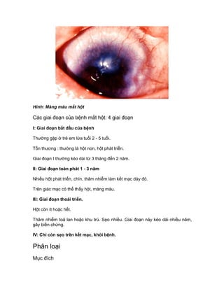 Hình: Màng máu mắt hột
Các giai đoạn của bệnh mắt hột: 4 giai đoạn
I: Giai đoạn bắt đầu của bệnh
Thường gặp ở trẻ em lứa tuổi 2 - 5 tuổi.
Tổn thương : thường là hột non, hột phát triển.
Giai đoạn I thường kéo dài từ 3 tháng đến 2 năm.
II: Giai đoạn toàn phát 1 - 3 năm
Nhiều hột phát triển, chín, thâm nhiễm làm kết mạc dày đỏ.
Trên giác mạc có thể thấy hột, màng máu.
III: Giai đoạn thoái triển.
Hột còn ít hoặc hết.
Thâm nhiễm toả lan hoặc khu trú. Sẹo nhiều. Giai đoạn này kéo dài nhiều năm,
gây biến chứng.
IV: Chỉ còn sẹo trên kết mạc, khỏi bệnh.
Phân loại
Mục đích
 