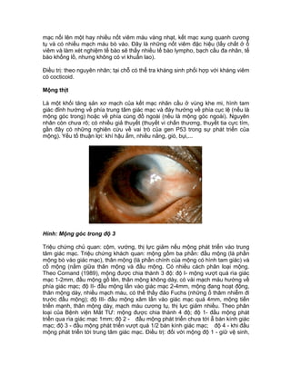 mạc nổi lên một hay nhiều nốt viêm màu vàng nhạt, kết mạc xung quanh cương
tụ và có nhiều mạch máu bò vào. Đây là những nốt viêm đặc hiệu (lấy chất ở ổ
viêm và làm xét nghiệm tế bào sẽ thấy nhiều tế bào lympho, bạch cầu đa nhân, tế
bào khổng lồ, nhưng không có vi khuẩn lao).
Điều trị: theo nguyên nhân; tại chỗ có thể tra kháng sinh phối hợp với kháng viêm
có cocticoid.
Mộng thịt
Là một khối tăng sản xơ mạch của kết mạc nhãn cầu ở vùng khe mi, hình tam
giác đỉnh hướng về phía trung tâm giác mạc và đáy hướng về phía cục lệ (nếu là
mộng góc trong) hoặc về phía cùng đồ ngoài (nếu là mộng góc ngoài). Nguyên
nhân còn chưa rõ; có nhiều giả thuyết (thuyết vi chấn thương, thuyết tia cực tím,
gần đây có những nghiên cứu về vai trò của gen P53 trong sự phát triển của
mộng). Yếu tố thuận lợi: khí hậu ẩm, nhiều nắng, gió, bụi,...
Hình: Mộng góc trong độ 3
Triệu chứng chủ quan: cộm, vướng, thị lực giảm nếu mộng phát triển vào trung
tâm giác mạc. Triệu chứng khách quan: mộng gồm ba phần: đầu mộng (là phần
mộng bò vào giác mạc), thân mộng (là phần chính của mộng có hình tam giác) và
cổ mộng (nằm giữa thân mộng và đầu mộng. Có nhiều cách phân loại mộng.
Theo Cornand (1989), mộng được chia thành 3 độ: độ I- mộng vượt quá rìa giác
mạc 1-2mm, đầu mộng gồ lên, thân mộng không dày, có vài mạch máu hướng về
phía giác mạc; độ II- đầu mộng lấn vào giác mạc 2-4mm, mộng đang hoạt động,
thân mộng dày, nhiều mạch máu, có thể thấy đảo Fuchs (những ổ thâm nhiễm đi
trước đầu mộng); độ III- đầu mộng xâm lấn vào giác mạc quá 4mm, mộng tiến
triển mạnh, thân mộng dày, mạch máu cương tụ, thị lực giảm nhiều. Theo phân
loại của Bệnh viện Mắt TƯ: mộng được chia thành 4 độ; độ 1- đầu mộng phát
triển qua rìa giác mạc 1mm; độ 2 - đầu mộng phát triển chưa tới ẵ bán kính giác
mạc; độ 3 - đầu mộng phát triển vượt quá 1/2 bán kính giác mạc; độ 4 - khi đầu
mộng phát triển tới trung tâm giác mạc. Điều trị: đối với mộng độ 1 - giữ vệ sinh,
 