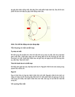 áp gây đứt chân mống mắt, đứt dây Zinn một phần hoặc toàn bộ. Sau đó là sức
phản hồi âm tính tiếp tục gây chấn động nhãn cầu.
Hình. Cơ chế tác động của lực đụng dập
Tổn thương mi mắt và kết mạc
Tụ máu mi mắt
Mi mắt sưng nề và bầm tím, khó mở mắt. Khi có tụ máu mi mắt, cần chú ý tới thời
gian xuất hiện. Xuất hiện ngay sau khi đụng dập là do tổn thương tại chỗ, tổn
thương ở mi mắt. Xuất hiện chậm sau vài giờ hay vài ngày là do tổn thương nền
sọ, dấu hiệu “đeo kính râm”.
Tràn khí dưới da mi và kết mạc
Sờ thấy cảm giác lạo xạo, lép bép dưới da mi. Nguyên nhân là do các xoang xung
quanh hốc mắt bị vỡ.
Sụp mi
Sụp mi làm khe mi hẹp lại, bệnh nhân khó mở mắt. Nguyên nhân là do rách cơ
nâng mi hoặc do tổn thương dây thần kinh III. Cần phân biệt với giả sụp mi là do
mắt sưng nề nhiều nên bệnh nhân khó mở mắt. Giả sụp mi sẽ hết khi mắt hết
sưng nề.
Vỡ xương hốc mắt
 