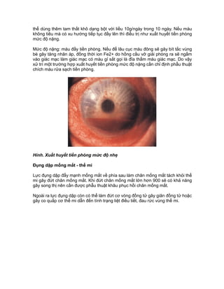 thể dùng thêm tam thất khô dạng bột với liều 10g/ngày trong 10 ngày. Nếu máu
không tiêu mà có xu hướng tiếp tục đầy lên thì điều trị như xuất huyết tiền phòng
mức độ nặng.
Mức độ nặng: máu đầy tiền phòng. Nếu để lâu cục máu đông sẽ gây bít tắc vùng
bè gây tăng nhãn áp, đồng thời ion Fe2+ do hồng cầu vỡ giải phóng ra sẽ ngấm
vào giác mạc làm giác mạc có màu gỉ sắt gọi là đĩa thấm máu giác mạc. Do vậy
xử trí một trường hợp xuất huyết tiền phòng mức độ nặng cần chỉ định phẫu thuật
chích máu rửa sạch tiền phòng.
Hình. Xuất huyết tiền phòng mức độ nhẹ
Đụng dập mống mắt - thể mi
Lực đụng dập đẩy mạnh mống mắt về phía sau làm chân mống mắt tách khỏi thể
mi gây đứt chân mống mắt. Khi đứt chân mống mắt lớn hơn 900 sẽ có khả năng
gây song thị nên cần được phẫu thuật khâu phục hồi chân mống mắt.
Ngoài ra lực đụng dập còn có thể làm đứt cơ vòng đồng tử gây giãn đồng tử hoặc
gây co quắp cơ thể mi dẫn đến tình trạng liệt điều tiết, đau rức vùng thể mi.
 