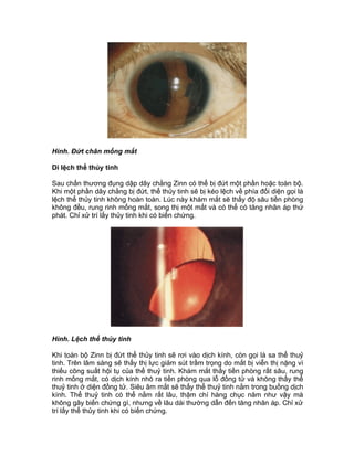 Hình. Đứt chân mống mắt
Di lệch thể thủy tinh
Sau chấn thương đụng dập dây chằng Zinn có thể bị đứt một phần hoặc toàn bộ.
Khi một phần dây chằng bị đứt, thể thủy tinh sẽ bị kéo lệch về phía đối diện gọi là
lệch thể thủy tinh không hoàn toàn. Lúc này khám mắt sẽ thấy độ sâu tiền phòng
không đều, rung rinh mống mắt, song thị một mắt và có thể có tăng nhãn áp thứ
phát. Chỉ xử trí lấy thủy tinh khi có biến chứng.
Hình. Lệch thể thủy tinh
Khi toàn bộ Zinn bị đứt thể thủy tinh sẽ rơi vào dịch kính, còn gọi là sa thể thuỷ
tinh. Trên lâm sàng sẽ thấy thị lực giảm sút trầm trọng do mắt bị viễn thị nặng vì
thiếu công suất hội tụ của thể thuỷ tinh. Khám mắt thấy tiền phòng rất sâu, rung
rinh mống mắt, có dịch kính nhô ra tiền phòng qua lỗ đồng tử và không thấy thể
thuỷ tinh ở diện đồng tử. Siêu âm mắt sẽ thấy thể thuỷ tinh nằm trong buồng dịch
kính. Thể thuỷ tinh có thể nằm rất lâu, thậm chí hàng chục năm như vậy mà
không gây biến chứng gì, nhưng về lâu dài thường dẫn đến tăng nhãn áp. Chỉ xử
trí lấy thể thủy tinh khi có biến chứng.
 