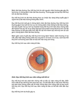 Bệnh đái tháo đường: Đục thể thuỷ tinh là một nguyên nhân thường gặp gây tổn
hại thị lực ở những bệnh nhân đái tháo đuường. Thường gặp hai loại đục thể thuỷ
tinh do đái tháo đường:
Đục thể thuỷ tinh do đái tháo đường thực sự (hoặc đục dạng bông tuyết) gặp ở
người trẻ bị đái tháo đường không điều chỉnh.
Đục thể thuỷ tinh tuổi già ở những bệnh nhân đái tháo đường: Đục thể thuỷ tinh
thường gặp ở lứa tuổi trẻ hơn so với những bệnh nhân không bị đái tháo đường.
Về mặt chuyển hoá sự tích luỹ Sorbitol trong thể thuỷ tinh kèm theo những biến
đổi Hydrat hoá sau đó và sự tăng Glycosyl hoá protein trong thể thuỷ tinh của đái
tháo đường có thể góp phần thúc đẩy tốc độ hình thành đục thể thuỷ tinh do tuổi
già ở những bệnh nhân đái tháo đường.
Bệnh giảm canxi huyết (đục thể thuỷ tinh trong bệnh Tetani): bệnh thường ở hai
mắt, biểu hiện bằng những chấm đục óng ánh ở vỏ trước và vỏ sau, dưới bao thể
thuỷ tinh và thường cách biệt với bao bởi một vùng còn trong.
Đục thể thuỷ tinh sau viêm màng bồ đào.
Hình: Đục thể thuỷ tinh sau viêm mống mắt thể mi
Đục thể thuỷ tinh thứ phát trên những mắt có tiền sử viêm màng bồ đào. Điển
hình nhất là đục thể thuỷ tinh dưới bao sau. Có thể biến đổi ở mặt trước thể thủy
tinh kèm theo những chấm sắc tố hoặc những đám dính mống mắt và bao trước
thể thủy tinh. Đục thể thuỷ tinh sau viêm màng bồ đào có thể tiến triển đến đục
chín.
Đục thể thuỷ tinh do thuốc gây ra.
 