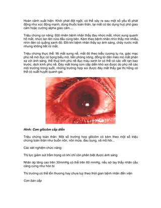 Hoàn cảnh xuất hiện: Khởi phát đột ngột, có thể xảy ra sau một số yếu tố phát
động như xúc động mạnh, dùng thuốc toàn thân, tại mắt có tác dụng huỷ phó giao
cảm hoặc cường alpha giao cảm....
Triệu chứng cơ năng: Đột nhiên bệnh nhân thấy đau nhức mắt, nhức xung quanh
hố mắt, nhức lan lên nửa đầu cùng bên. Kèm theo bệnh nhân nhìn thấy mờ nhiều,
nhìn đèn có quầng xanh đỏ. Đôi khi bệnh nhân thấy sợ ánh sáng, chảy nước mắt
nhưng không tiết rử mắt.
Triệu chứng thực thể: Mi mắt sưng nề, mắt đỏ theo kiểu cương tụ rìa, giác mạc
phù nề mờ đục có bọng biểu mô, tiền phòng nông, đồng tử dãn méo mó mất phản
xạ với ánh sáng, thể thuỷ tinh phù nề đục màu xanh lơ có thể có các vết rạn bao
trước, dịch kính phù nề. Đáy mắt trong cơn cấp diễn khó soi được do phù nề các
môi trường trong suốt, những trường hợp soi được đáy mắt thấy gai thị hồng có
thể có xuất huyết quanh gai.
Hình: Cơn glôcôm cấp diễn
Triệu chứng toàn thân: Một số trường hợp glôcôm có kèm theo một số triệu
chứng toàn thân như buồn nôn, nôn mửa, đau bụng, vã mồ hôi...
Các xét nghiệm chức năng:
Thị lực giảm sút trầm trọng có khi chỉ còn phân biệt được ánh sáng
Nhãn áp tăng cao trên 30mmHg có thể trên 60 mmHg, nếu sờ tay thấy nhãn cầu
căng cứng như hòn bi
Thị trường có thể tổn thương hay chưa tuỳ theo thời gian bệnh nhân đến viện
Cơn bán cấp
 