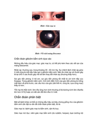 Chẩn đoán glôcôm bẩm sinh dựa vào
Những dấu hiệu của giác mạc: giác mạc to, có thể phù kèm theo các vết rạn của
màng Descemet.
Nhãn áp: thường cao, trong khoảng 30 - 40 mm Hg. Sự chênh lệch nhãn áp giữa
2 mắt cũng là một dấu hiệu gợi ý glôcôm bẩm sinh. Nên đo nhãn áp với thuốc gây
tê tại chỗ vì các thuốc gây mê sẽ làm thay đổi nhãn áp (thường thấp hơn).
Soi góc tiền phòng: ở trẻ em, soi góc tiền phòng tốt nhất là với kính tiếp xúc
Koeppe. Trong glôcôm bẩm sinh, hình ảnh điển hình của góc tiền phòng là mống
mắt bám về phía trước, các cấu trúc của góc (dải thể mi, vùng bè, cựa củng mạc)
thấy rõ hơn.
Tổn hại thị thần kinh: lõm đĩa rộng hơn bình thường (tỉ lệ đường kính lõm đĩa/đĩa
lớn hơn 3/10) hoặc có mất cân đối lõm đĩa ở 2 mắt.
Chẩn đoán phân biệt
Một số bệnh khác có thể có những dấu hiệu và triệu chứng giống như của glôcôm
bẩm sinh cần đặt ra vấn đề chẩn đoán phân biệt, đó là:
Giác mạc to: bệnh giác mạc to bẩm sinh, cận thị trục.
Giác mạc mờ đục: viêm giác mạc bẩm sinh (do rubêôn, herpes), loạn dưỡng nội
 