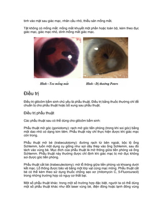 tinh vào mặt sau giác mạc, nhãn cầu nhỏ, thiểu sản mống mắt.
Tật không có mống mắt: mống mắt khuyết một phần hoặc toàn bộ, kèm theo đục
giác mạc, giác mạc nhỏ, dính mống mắt giác mạc.
Điều trị
Điều trị glôcôm bẩm sinh chủ yếu là phẫu thuật. Điều trị bằng thuốc thường chỉ để
chuẩn bị cho phẫu thuật hoặc bổ xung sau phẫu thuật.
Điều trị phẫu thuật
Các phẫu thuật sau có thể dùng cho glôcôm bẩm sinh:
Phẫu thuật mở góc (goniotomy): rạch mở góc tiền phòng (trong khi soi góc) bằng
một dao nhỏ có dạng kim tiêm. Phẫu thuật này chỉ thực hiện được khi giác mạc
còn trong.
Phẫu thuật mở bè (trabeculotomy): đường rạch từ bên ngoài, bộc lộ ống
Schlemm, luồn một dụng cụ giống như sợi dây thép vào ống Schlemm, sau đó
tách vào vùng bè. Mục đích của phẫu thuật là mở thông giữa tiền phòng và ống
Schlemm. Phẫu thuật này thường được chỉ định khi giác mạc bị mờ đục không
soi được góc tiền phòng.
Phẫu thuật cắt bè (trabeculectomy): mở lỗ thông giữa tiền phòng và khoang dưới
kết mạc. Lỗ thông được bảo vệ bằng một lớp vạt củng mạc mỏng. Phẫu thuật cắt
bè có thể kèm theo sử dụng thuốc chống sẹo xơ (mitomycin C, 5-Fluorouracil)
trong những trường hợp có nguy cơ thất bại.
Một số phẫu thuật khác: trong một số trường hợp đặc biệt, người ta có thể dùng
một số phẫu thuật khác như đốt laser vùng bè, điện đông hoặc lạnh đông vùng
 