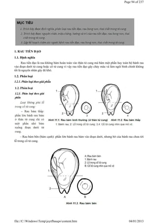 1. RAU TIỀN ĐẠO
1.1. Định nghĩa
Rau tiền đạo là rau không bám hoàn toàn vào thân tử cung mà bám một phần hay toàn bộ bánh rau
vào đoạn dưới tử cung hoặc cổ tử cung vì vậy rau tiền đạo gây chảy máu và làm ngôi bình chỉnh không
tốt là nguyên nhân gây đẻ khó.
1.2. Phân loại
1.2.1. Phân loại theo giải phẫu
– Rau bám bên (bám cạnh): phần lớn bánh rau bám vào đoạn dưới, nhưng bờ của bánh rau chưa tới
lỗ trong cổ tử cung.
Page 94 of 237
04/01/2013
file://C:WindowsTempjoytfbauqwcontent.htm
 