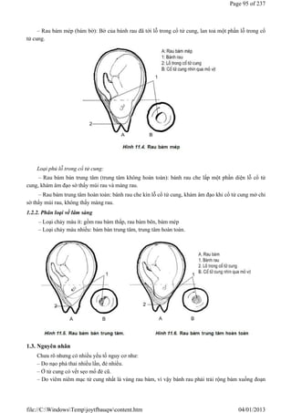 – Rau bám mép (bám bờ): Bờ của bánh rau đã tới lỗ trong cổ tử cung, lan toả một phần lỗ trong cổ
tử cung.
Loại phủ lỗ trong cổ tử cung:
– Rau bám bán trung tâm (trung tâm không hoàn toàn): bánh rau che lấp một phần diện lỗ cổ tử
cung, khám âm đạo sờ thấy múi rau và màng rau.
– Rau bám trung tâm hoàn toàn: bánh rau che kín lỗ cổ tử cung, khám âm đạo khi cổ tử cung mở chỉ
sờ thấy múi rau, không thấy màng rau.
1.2.2. Phân loại về lâm sàng
– Loại chảy máu ít: gồm rau bám thấp, rau bám bên, bám mép
– Loại chảy máu nhiều: bám bán trung tâm, trung tâm hoàn toàn.
1.3. Nguyên nhân
Chưa rõ nhưng có nhiều yếu tố nguy cơ như:
– Do nạo phá thai nhiều lần, đẻ nhiều.
– Ở tử cung có vết sẹo mổ đẻ cũ.
– Do viêm niêm mạc tử cung nhất là vùng rau bám, vì vậy bánh rau phải trải rộng bám xuống đoạn
Page 95 of 237
04/01/2013
file://C:WindowsTempjoytfbauqwcontent.htm
 