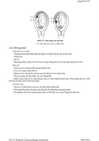 2.4.2. Thể trung bình
Toàn thân và cơ năng
– Thường có biểu hiện nhiễm độc thai nghén rõ: tăng huyết áp, phù, protein niệu.
– Thiếu máu.
– Sốc rõ.
– Đau bụng nhiều, từng cơn do cơn co tử cung cường tính và tử cung tăng trương lực rõ rệt.
Thực thể
– Chiều cao tử cung tăng dần nhưng không rõ rệt.
– Cơn co tử cung cường tính rõ.
– Ngoài cơn co, trương lực của tử cung vẫn tăng rõ, sờ tử cung cứng.
– Thai suy nặng: tim thai chậm, rời rạc, không đều.
– Khám trong: thấy cổ tử cung thường cứng, có máu loãng đỏ hoặc đen, không đông theo tay. Nếu
đã vỡ ối, sẽ thấy nước ối lẫn máu loãng.
Cận lâm sàng
– Siêu âm: có khối máu tụ sau rau, tim thai chậm, không đều.
– Chức năng đông máu: máu chảy, máu đông kéo dài, fibrinogen máu giảm mạnh.
– Xét nghiệm nước tiểu: ngoài protein niệu, có thể thấy có trụ niệu, hồng cầu, bạch cầu...
Page 99 of 237
04/01/2013
file://C:WindowsTempjoytfbauqwcontent.htm
Tải bản FULL (237 trang): https://bit.ly/3wYwy22
Dự phòng: fb.com/TaiHo123doc.net
 