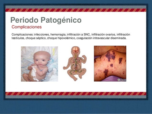 Hematoma Retrocorial Y Síndrome De Down