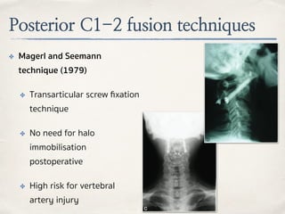 Posterior C1-2 fusion techniques
✤ Magerl and Seemann
technique (1979)
✤ Transarticular screw ﬁxation
technique
✤ No need for halo
immobilisation
postoperative
✤ High risk for vertebral
artery injury
 