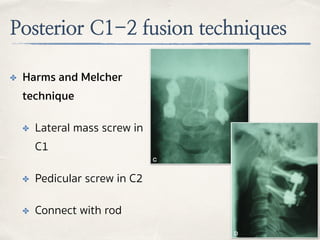 Posterior C1-2 fusion techniques
✤ Harms and Melcher
technique
✤ Lateral mass screw in
C1
✤ Pedicular screw in C2
✤ Connect with rod
 