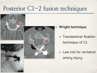 Posterior C1-2 fusion techniques
✤ Wright technique
✤ Translaminar ﬁxation
technique of C2
✤ Low risk for vertebral
artery injury
C1
C2
 