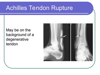 Ta Rupture rupture-Achilles-Tendon and management-ppt.ppt