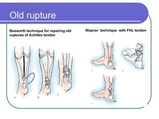 Ta Rupture ruptur Achilles-Tendon and management-ppt.ppt