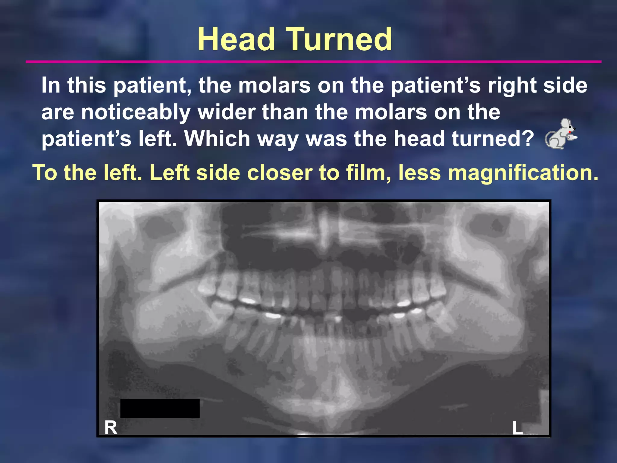 Head Turned
In this patient, the molars on the patient’s right side
are noticeably wider than the molars on the
patient’s left. Which way was the head turned?
To the left. Left side closer to film, less magnification.




       R                                         L
 