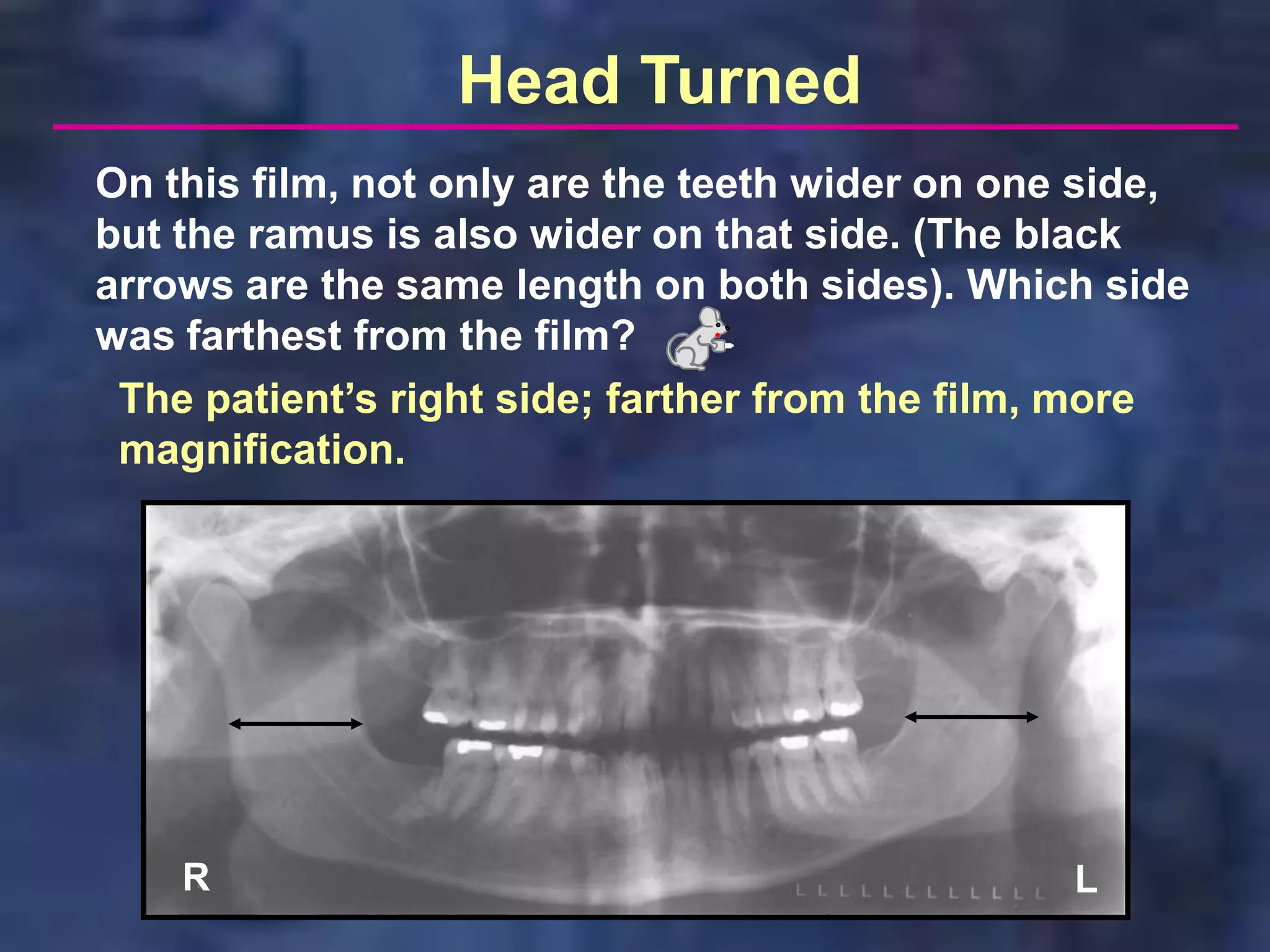 Head Turned
On this film, not only are the teeth wider on one side,
but the ramus is also wider on that side. (The black
arrows are the same length on both sides). Which side
was farthest from the film?
 The patient’s right side; farther from the film, more
 magnification.




    R                                            L
 