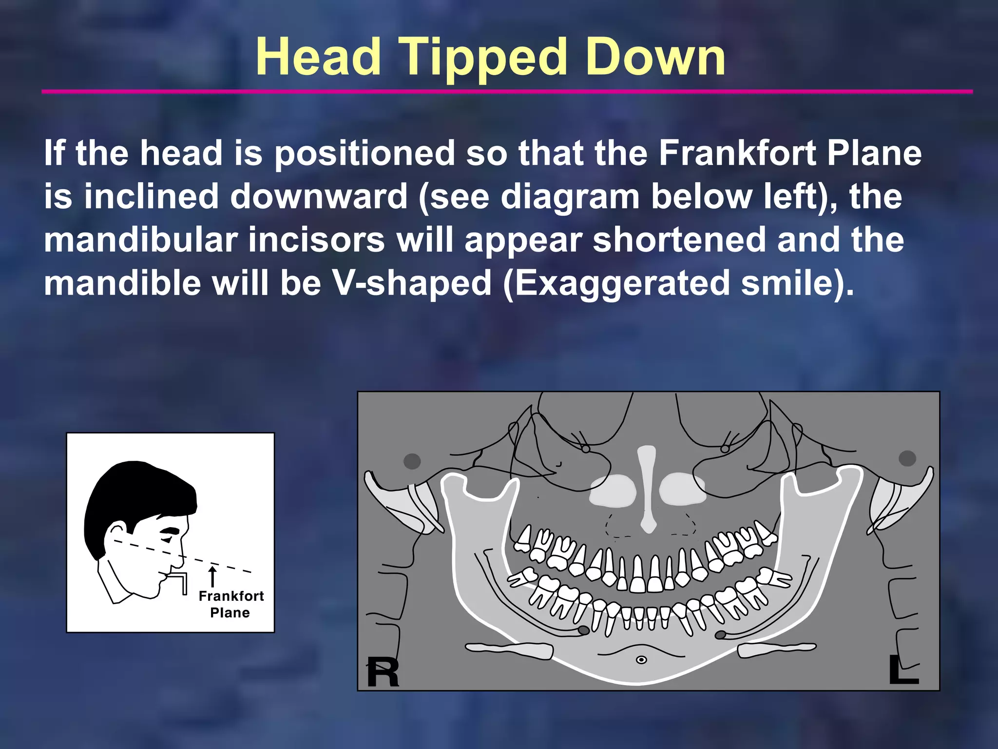 Head Tipped Down
If the head is positioned so that the Frankfort Plane
is inclined downward (see diagram below left), the
mandibular incisors will appear shortened and the
mandible will be V-shaped (Exaggerated smile).
 