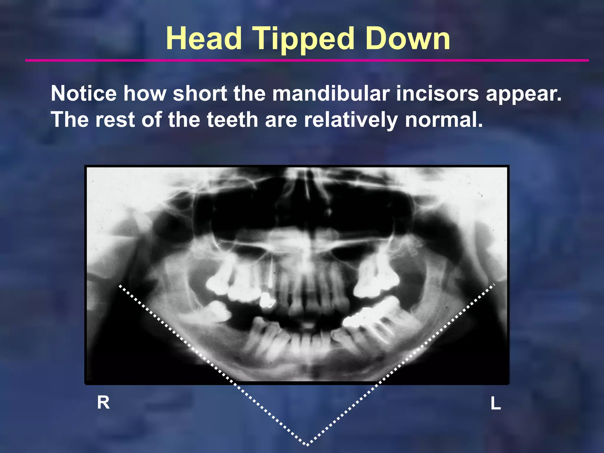 Head Tipped Down
Notice how short the mandibular incisors appear.
The rest of the teeth are relatively normal.




    R                                    L
 