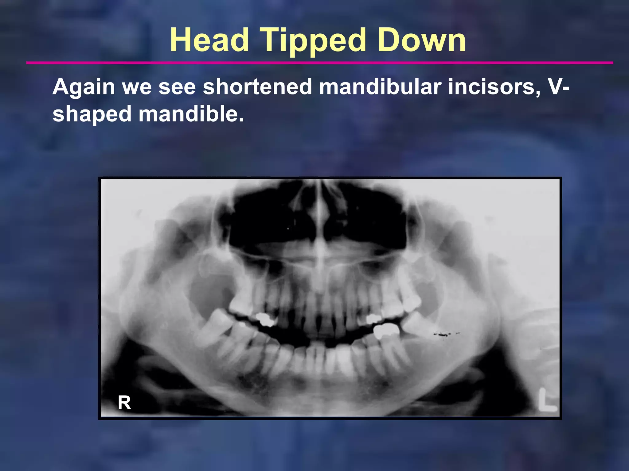 Head Tipped Down
Again we see shortened mandibular incisors, V-
shaped mandible.




     R
 