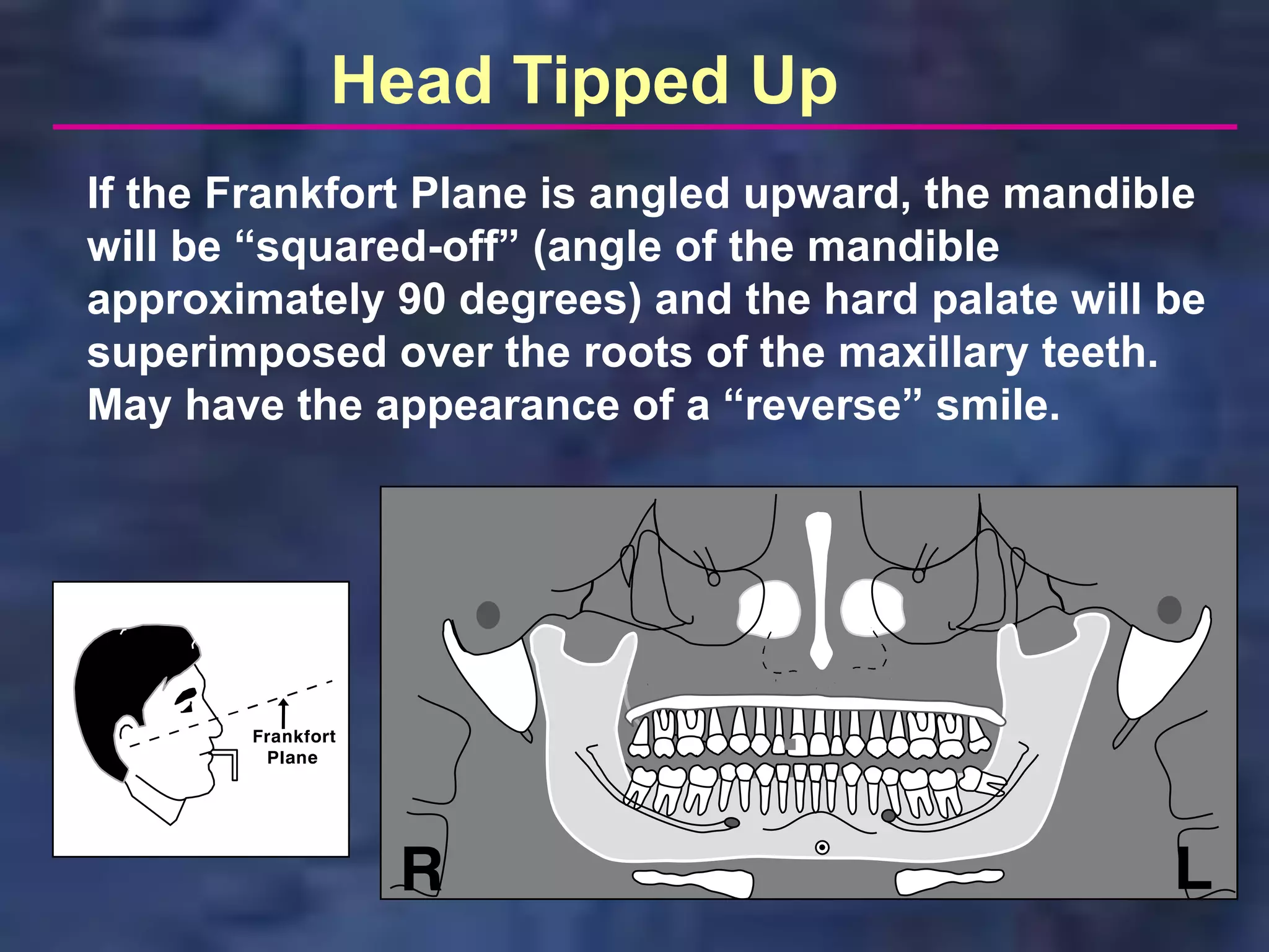Head Tipped Up
If the Frankfort Plane is angled upward, the mandible
will be “squared-off” (angle of the mandible
approximately 90 degrees) and the hard palate will be
superimposed over the roots of the maxillary teeth.
May have the appearance of a “reverse” smile.
 