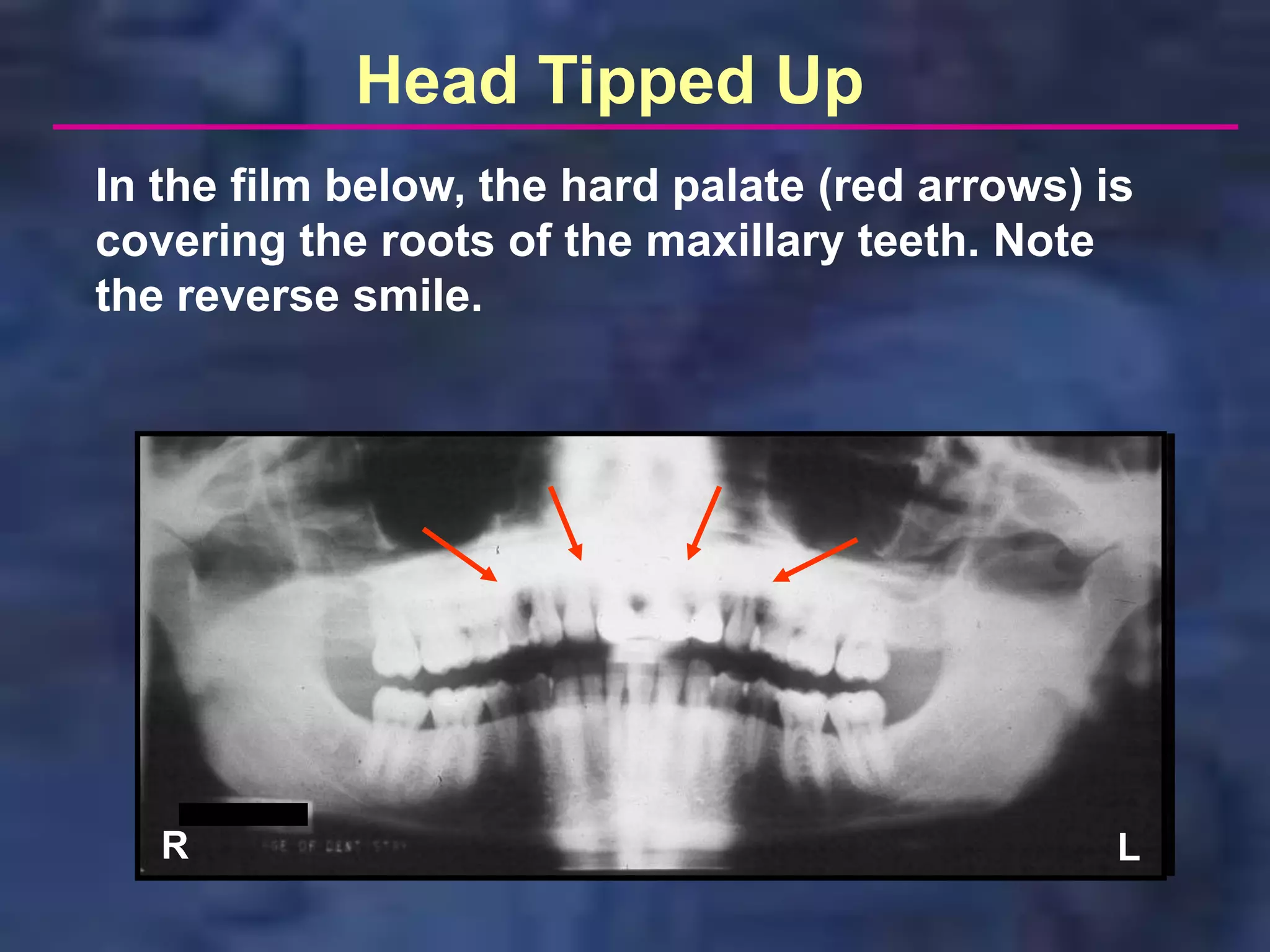 Head Tipped Up
In the film below, the hard palate (red arrows) is
covering the roots of the maxillary teeth. Note
the reverse smile.




   R                                             L
 