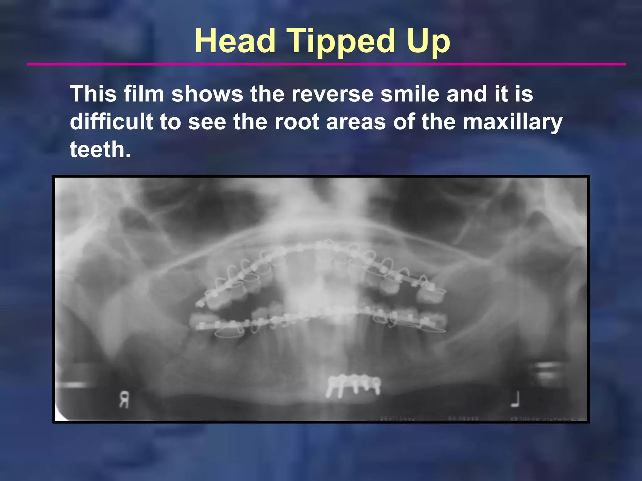 Head Tipped Up
This film shows the reverse smile and it is
difficult to see the root areas of the maxillary
teeth.
 