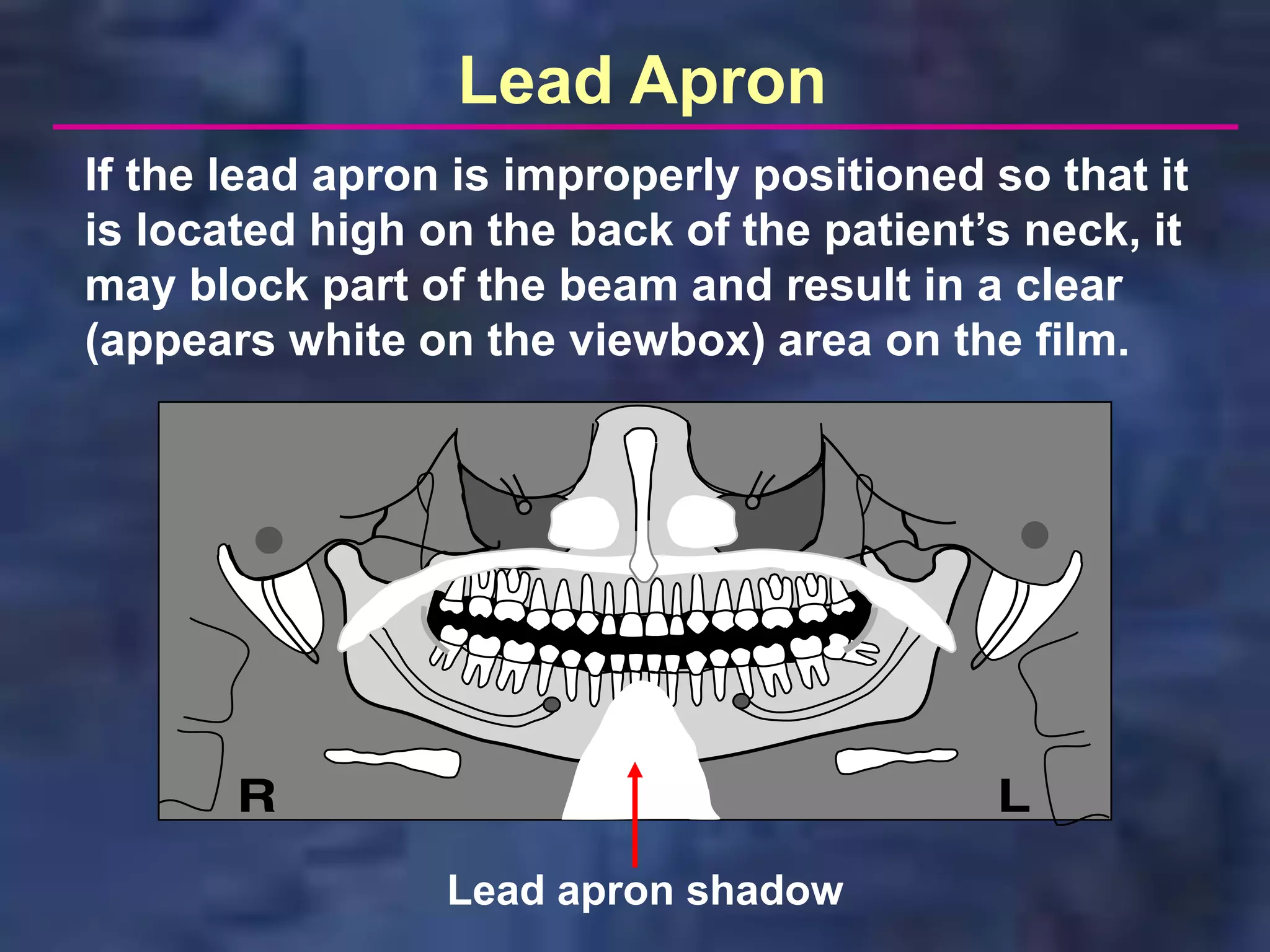 Lead Apron
If the lead apron is improperly positioned so that it
is located high on the back of the patient’s neck, it
may block part of the beam and result in a clear
(appears white on the viewbox) area on the film.




                 Lead apron shadow
 