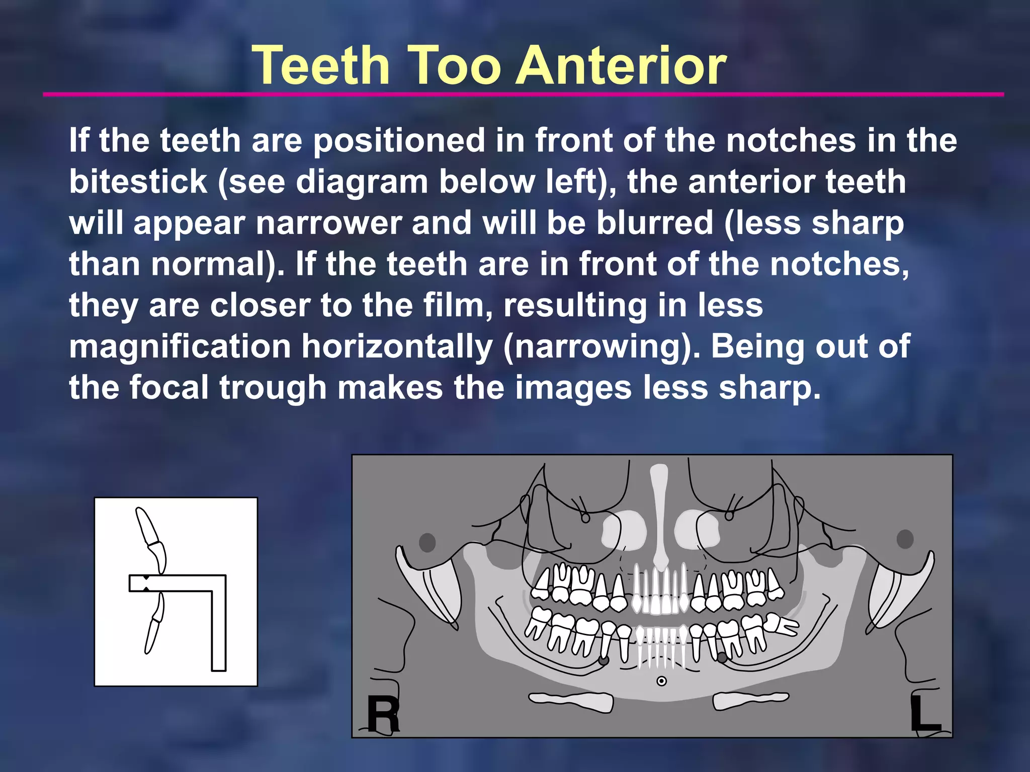 Teeth Too Anterior
If the teeth are positioned in front of the notches in the
bitestick (see diagram below left), the anterior teeth
will appear narrower and will be blurred (less sharp
than normal). If the teeth are in front of the notches,
they are closer to the film, resulting in less
magnification horizontally (narrowing). Being out of
the focal trough makes the images less sharp.
 