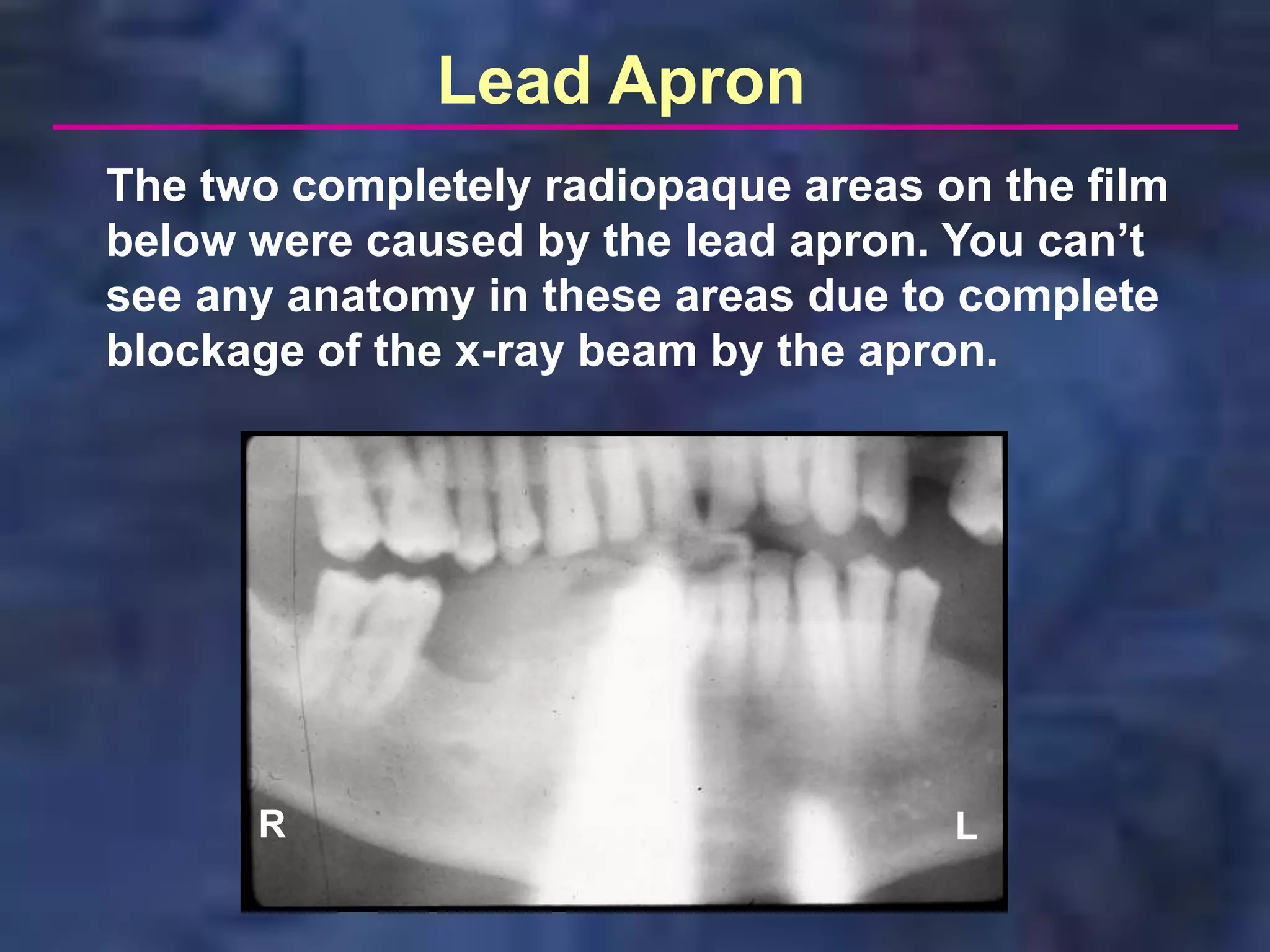 Lead Apron
The two completely radiopaque areas on the film
below were caused by the lead apron. You can’t
see any anatomy in these areas due to complete
blockage of the x-ray beam by the apron.




      R                              L
 