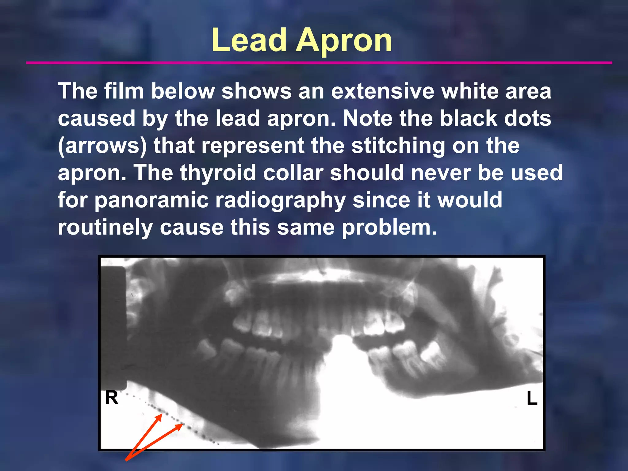 Lead Apron
The film below shows an extensive white area
caused by the lead apron. Note the black dots
(arrows) that represent the stitching on the
apron. The thyroid collar should never be used
for panoramic radiography since it would
routinely cause this same problem.




    R                                     L
 