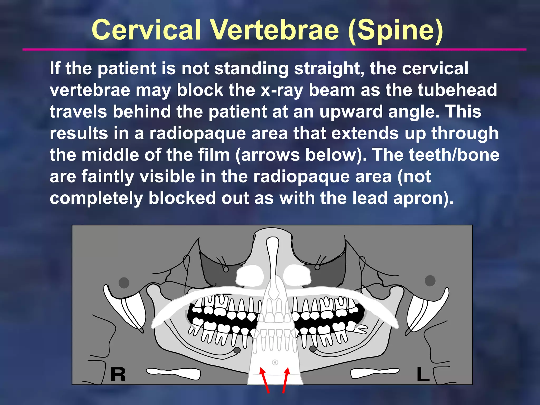Cervical Vertebrae (Spine)
If the patient is not standing straight, the cervical
vertebrae may block the x-ray beam as the tubehead
travels behind the patient at an upward angle. This
results in a radiopaque area that extends up through
the middle of the film (arrows below). The teeth/bone
are faintly visible in the radiopaque area (not
completely blocked out as with the lead apron).
 