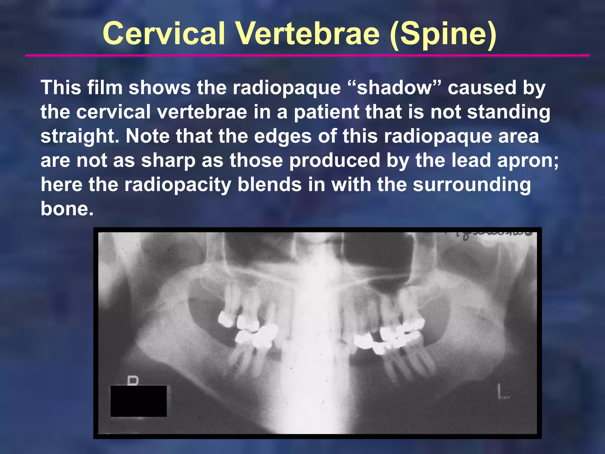 Cervical Vertebrae (Spine)
This film shows the radiopaque “shadow” caused by
the cervical vertebrae in a patient that is not standing
straight. Note that the edges of this radiopaque area
are not as sharp as those produced by the lead apron;
here the radiopacity blends in with the surrounding
bone.
 