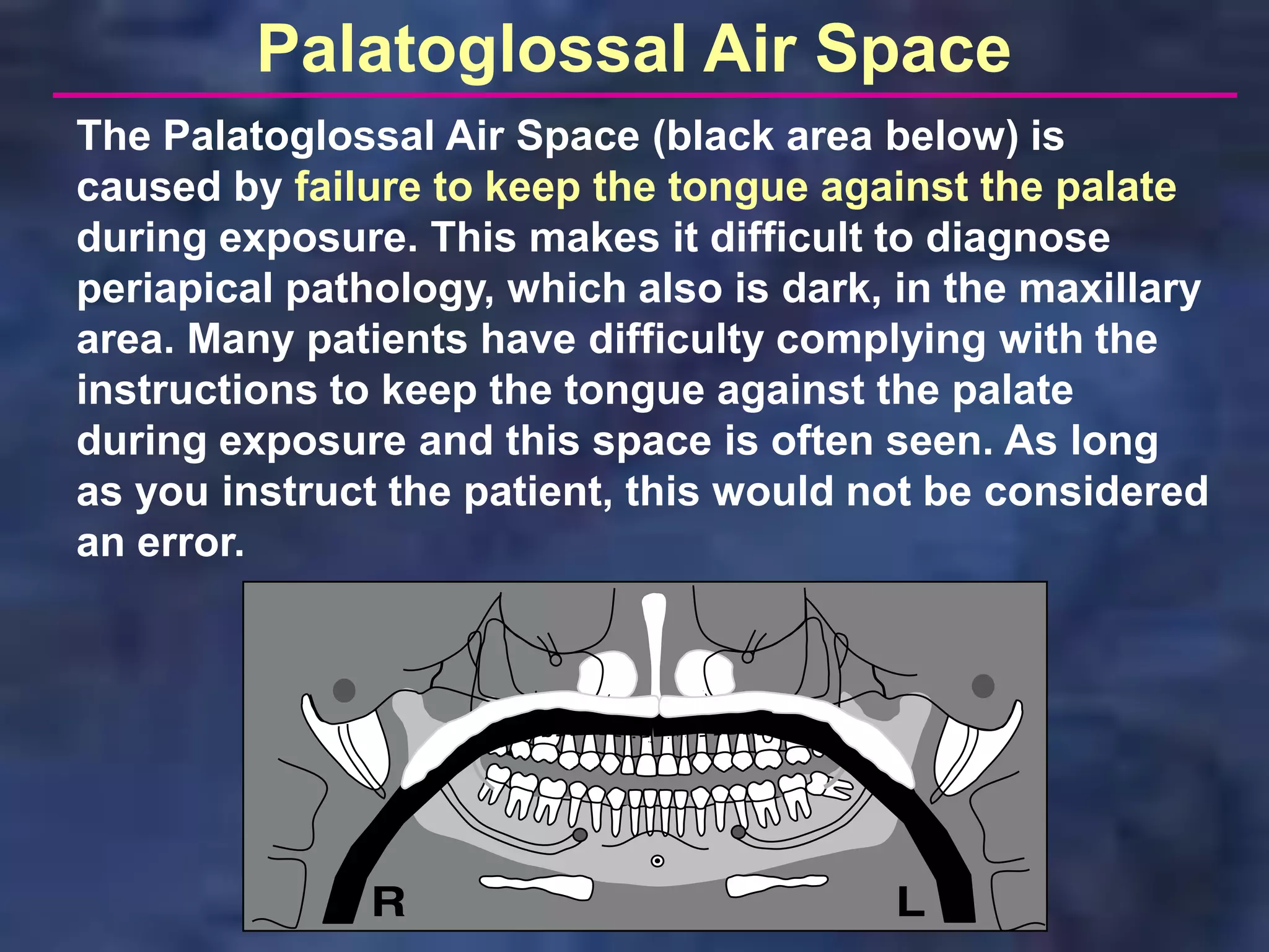 Palatoglossal Air Space
The Palatoglossal Air Space (black area below) is
caused by failure to keep the tongue against the palate
during exposure. This makes it difficult to diagnose
periapical pathology, which also is dark, in the maxillary
area. Many patients have difficulty complying with the
instructions to keep the tongue against the palate
during exposure and this space is often seen. As long
as you instruct the patient, this would not be considered
an error.
 